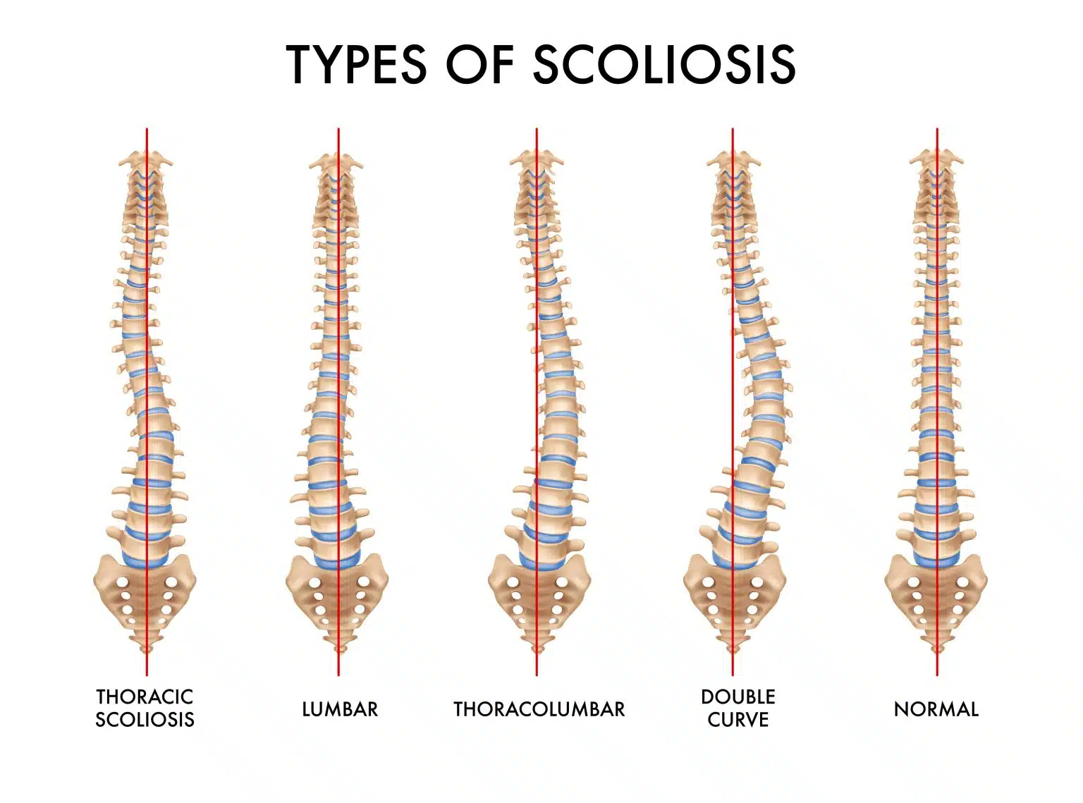 What Is a Scoliosis? Diagnosis and Treatment Recommendations