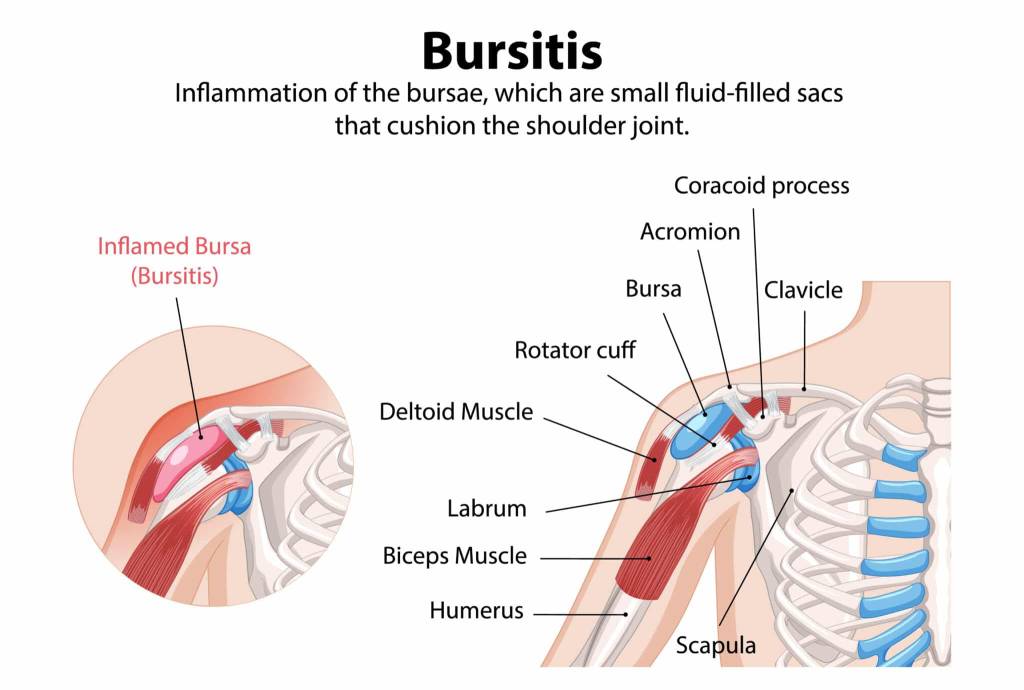 Shoulder Bursitis